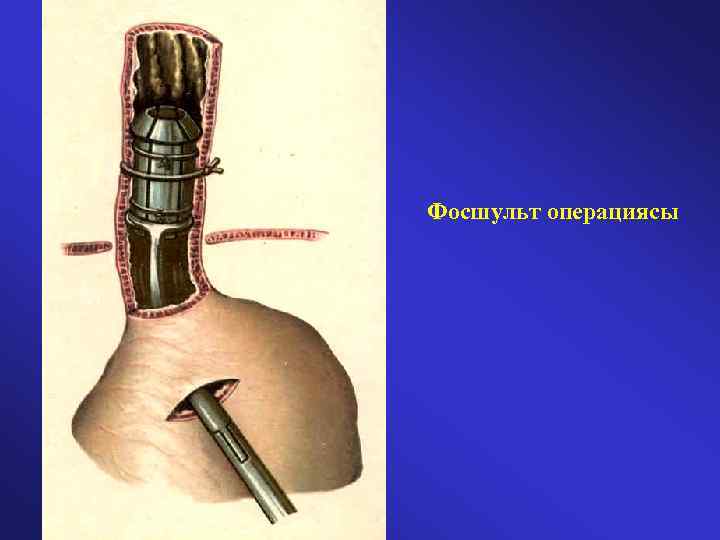 Фосшульт операциясы 