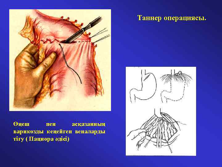 Таннер операциясы. Өңеш пен асқазанның варикозды кеңейген веналарды тігу ( Пациора әдісі) 