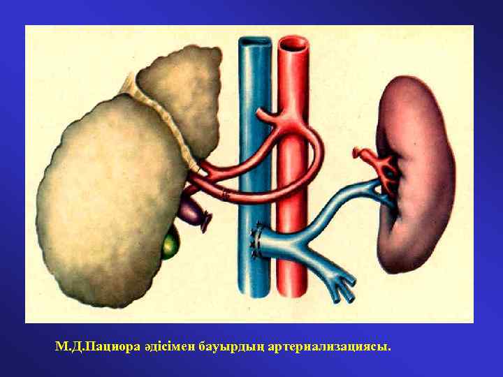 М. Д. Пациора әдісімен бауырдың артериализациясы. 