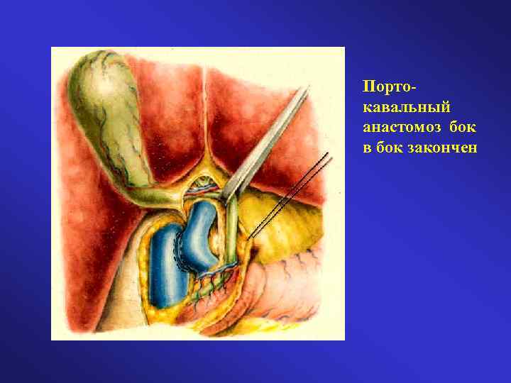 Портокавальный анастомоз бок в бок закончен 