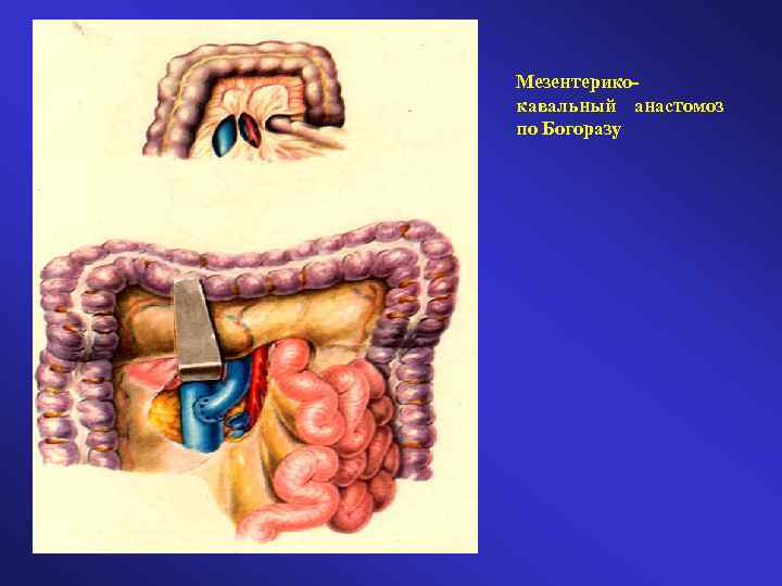 Мезентерикокавальный анастомоз по Богоразу 