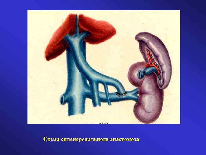 Схема спленоренального анастомоза 