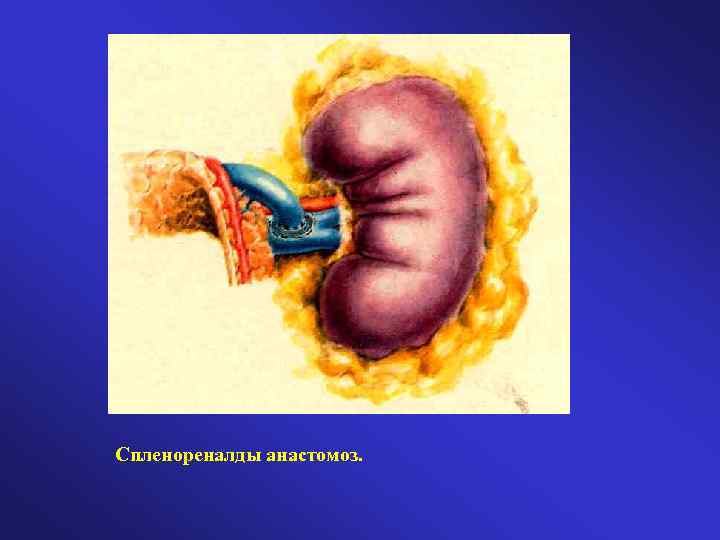 Спленореналды анастомоз. 