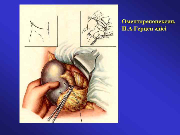 Оменторенопексия. П. А. Герцен әдісі 