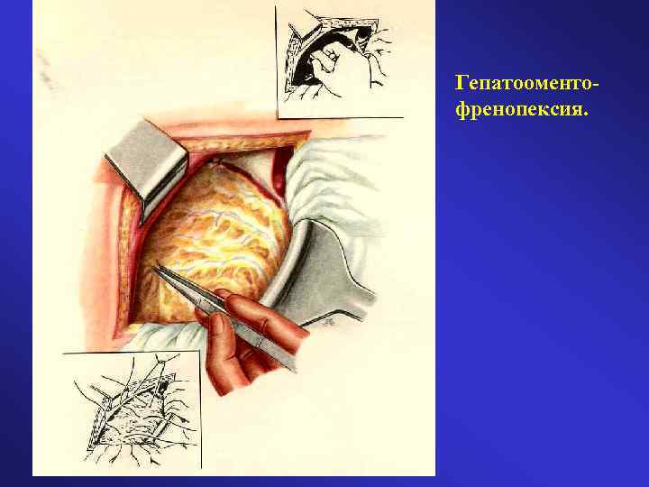 Гепатооментофренопексия. 