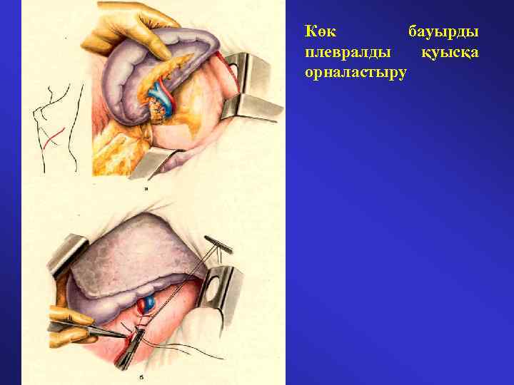 Көк бауырды плевралды қуысқа орналастыру 