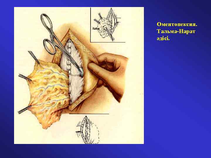 Оментопексия. Тальма-Нарат әдісі. 