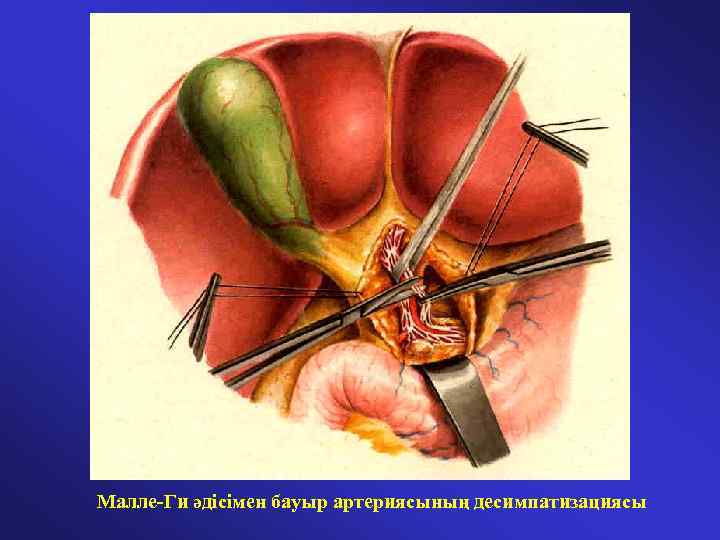 Малле-Ги әдісімен бауыр артериясының десимпатизациясы 