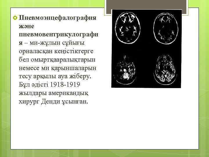  Пневмоэнцефалография және пневмовентрикулографи я – ми-жұлын сұйығы орналасқан кеңістіктерге бел омыртқааралықтарын немесе ми