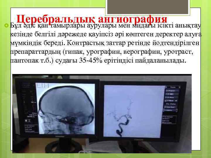 Церебральдық ангиография анықтау Бұл әдіс қан тамырлары аурулары мен мидағы ісікті кезінде белгілі дәрежеде