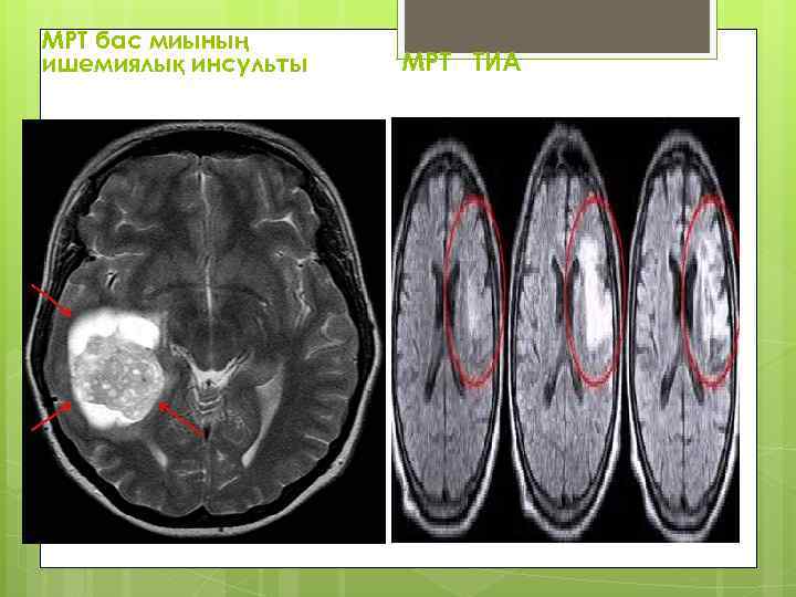 МРТ бас миының ишемиялық инсульты МРТ ТИА 