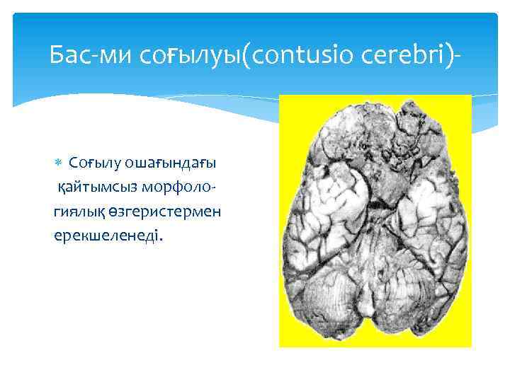 Бас-ми соғылуы(contusio cerebri)- Соғылу ошағындағы қайтымсыз морфологиялық өзгеристермен ерекшеленеді. 