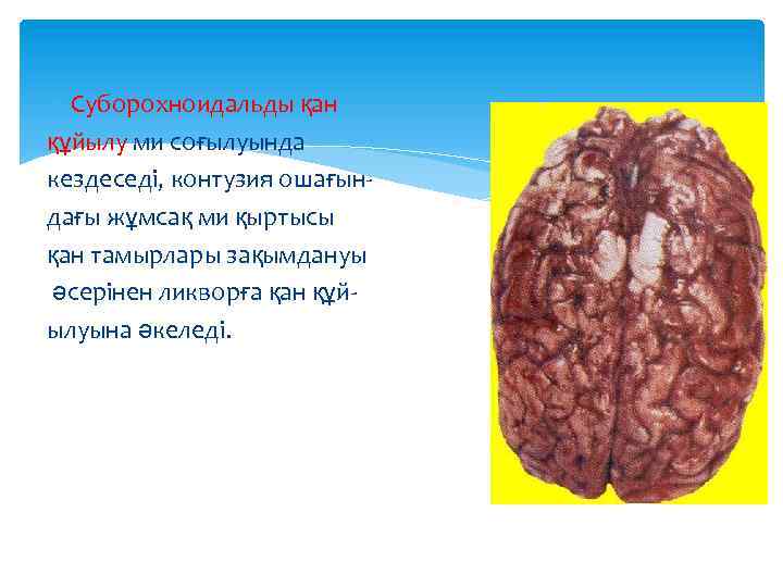  Суборохноидальды қан құйылу ми соғылуында кездеседі, контузия ошағындағы жұмсақ ми қыртысы қан тамырлары