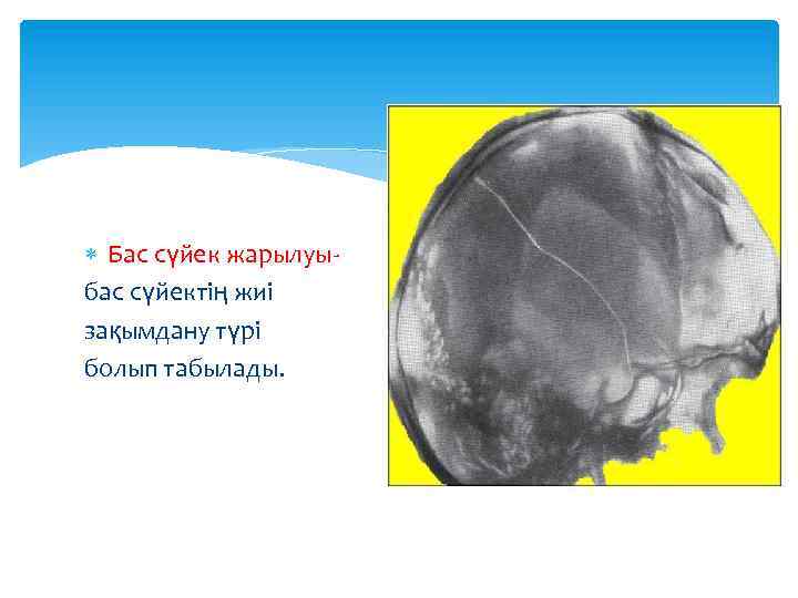  Бас сүйек жарылуыбас сүйектің жиі зақымдану түрі болып табылады. 