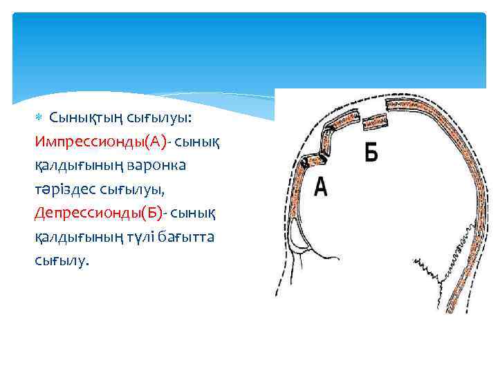  Сынықтың сығылуы: Импрессионды(А)- сынық қалдығының варонка тәріздес сығылуы, Депрессионды(Б)- сынық қалдығының түлі бағытта