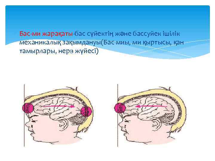  Бас-ми жарақаты-бас сүйектің және бассуйек ішілік механикалық зақымдануы(Бас миы, ми қыртысы, қан тамырлары,