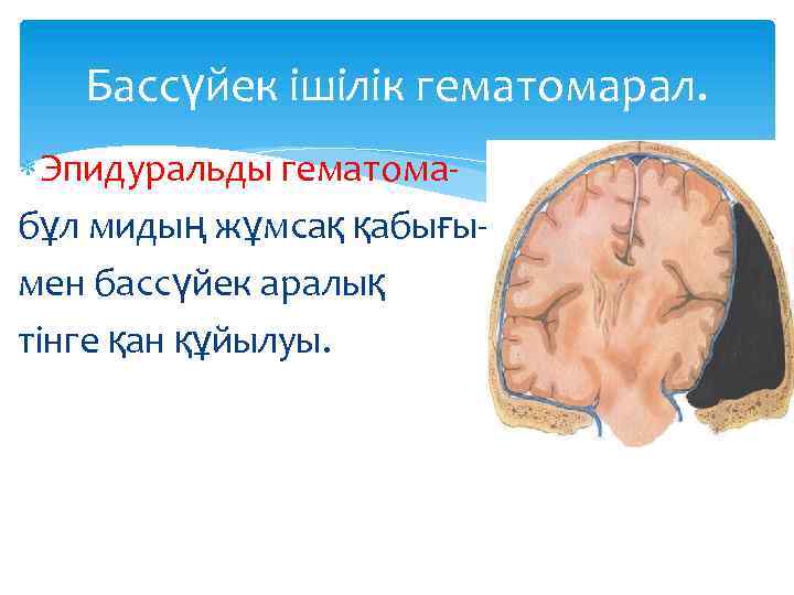 Бассүйек ішілік гематомарал. Эпидуральды гематомабұл мидың жұмсақ қабығымен бассүйек аралық тінге қан құйылуы. 