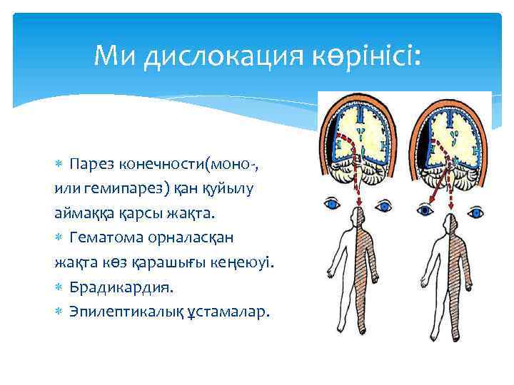 Ми дислокация көрінісі: Парез конечности(моно-, или гемипарез) қан қуйылу аймаққа қарсы жақта. Гематома орналасқан