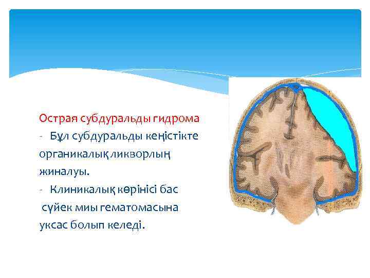 Острая субдуральды гидрома - Бұл субдуральды кеңістікте органикалық ликворлың жиналуы. - Клиникалық көрінісі бас