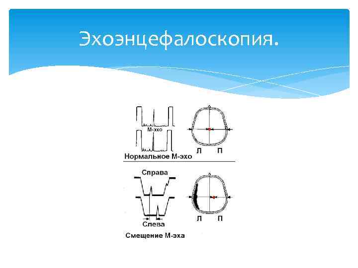 Эхоэнцефалоскопия. 