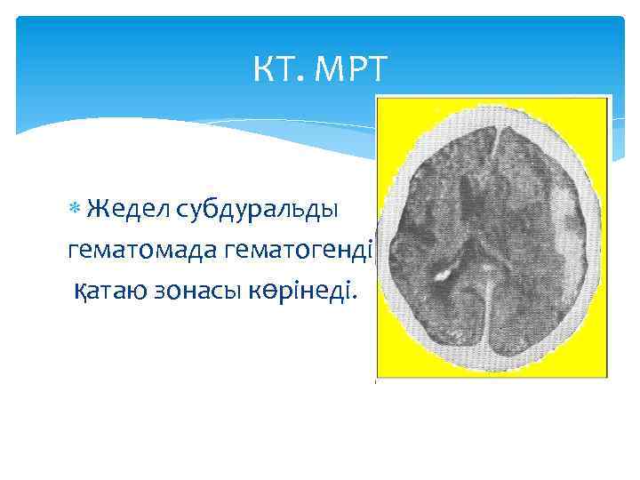 КТ. МРТ Жедел субдуральды гематомада гематогенді қатаю зонасы көрінеді. 