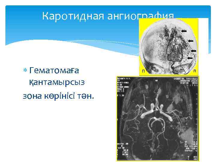 Каротидная ангиография Гематомаға қантамырсыз зона көрінісі тән. 