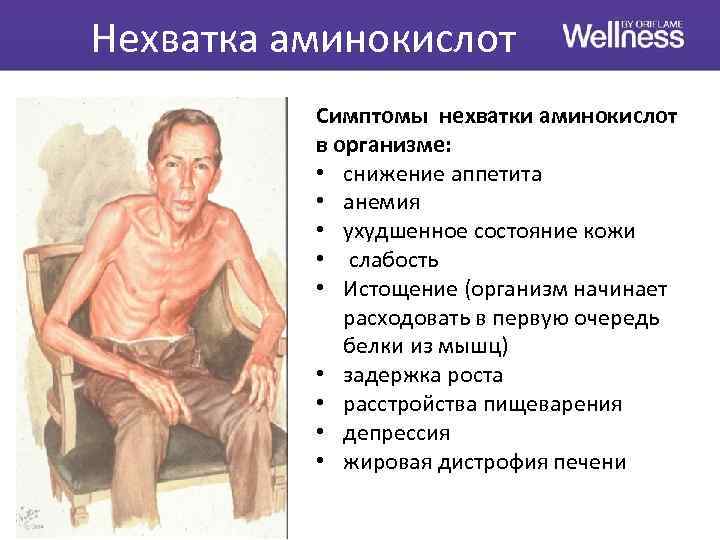 Нехватка аминокислот Симптомы нехватки аминокислот в организме: • снижение аппетита • анемия • ухудшенное