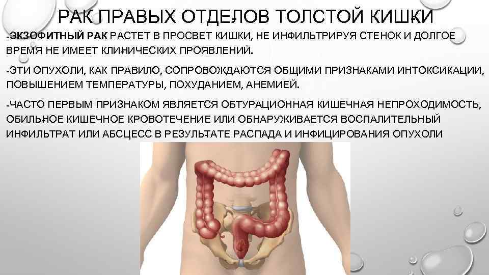 РАК ПРАВЫХ ОТДЕ ОВ ТОЛСТОЙ КИШ И Л К -ЭКЗОФИТНЫЙ РАК РАСТЕТ В ПРОСВЕТ