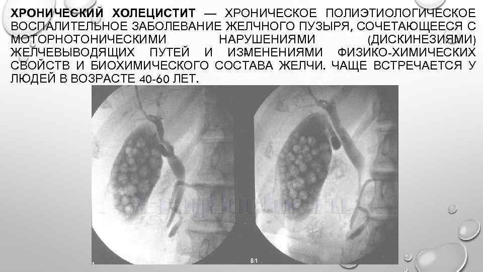 ХРОНИЧЕСКИЙ ХОЛЕЦИСТИТ — ХРОНИЧЕСКОЕ ПОЛИЭТИОЛОГИЧЕСКОЕ ВОСПАЛИТЕЛЬНОЕ ЗАБОЛЕВАНИЕ ЖЕЛЧНОГО ПУЗЫРЯ, СОЧЕТАЮЩЕЕСЯ С МОТОРНО ОНИЧЕСКИМИ Т