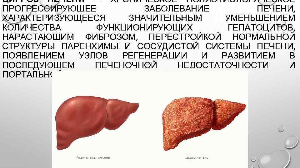 ЦИРРОЗ ПЕЧЕНИ — ХРОНИЧЕСКОЕ ПОЛИЭТИОЛОГИЧЕСКОЕ ПРОГРЕССИРУЮЩЕЕ ЗАБОЛЕВАНИЕ ПЕЧЕНИ, ХАРАКТЕРИЗУЮЩЕЕСЯ ЗНАЧИТЕЛЬ ЫМ Н УМЕНЬШЕНИЕМ КОЛИЧЕСТВА