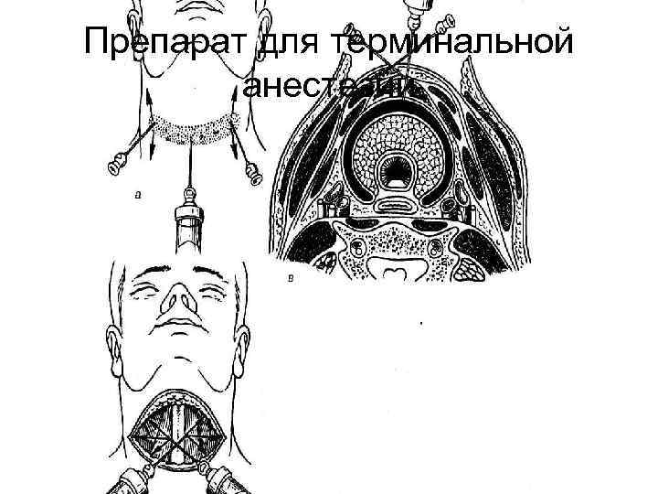 Препарат для терминальной анестезии 