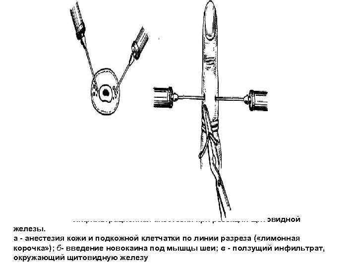 Инфильтрационная анестезия при резекции щитовидной железы. а - анестезия кожи и подкожной клетчатки по