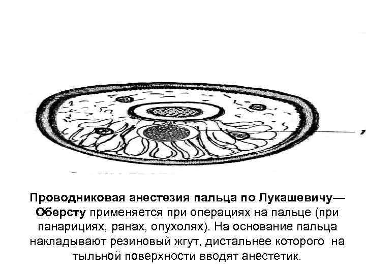 Проводниковая анестезия пальца по Лукашевичу— Оберсту применяется при операциях на пальце (при панарициях, ранах,