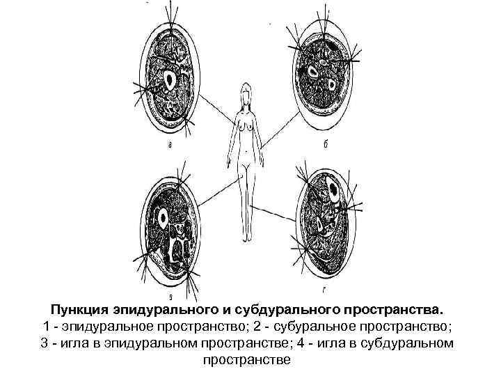Пункция эпидурального и субдурального пространства. 1 эпидуральное пространство; 2 субуральное пространство; 3 игла в