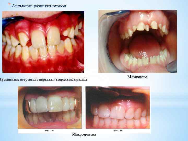 * Аномалии развития резцов Мезиоденс Макродентия 