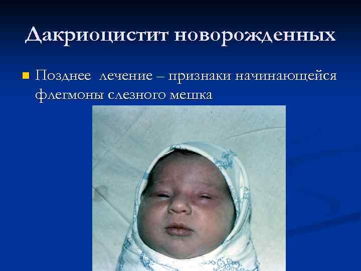Дакриоцистит новорожденных n Позднее лечение – признаки начинающейся флегмоны слезного мешка 