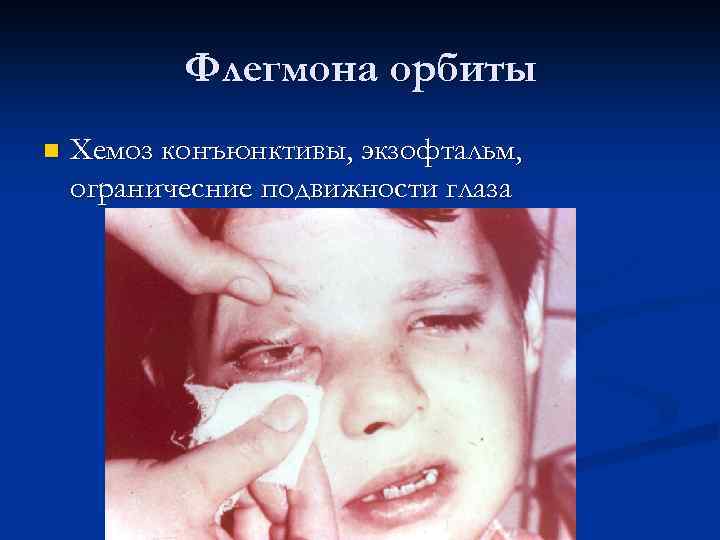 Флегмона орбиты n Хемоз конъюнктивы, экзофтальм, ограничесние подвижности глаза 