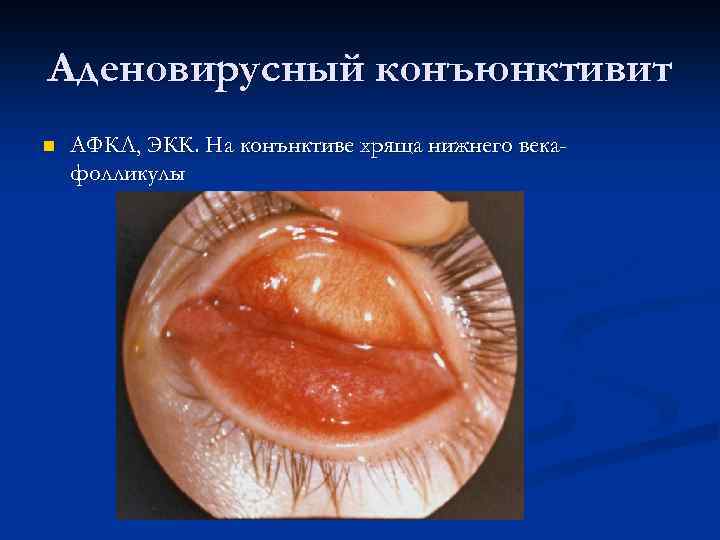 Аденовирусный конъюнктивит n АФКЛ, ЭКК. На конънктиве хряща нижнего векафолликулы 