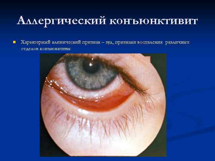 Аллергический конъюнктивит n Характерный клинический признак – зуд, признаки воспаления различных отделов конъюнктивы 