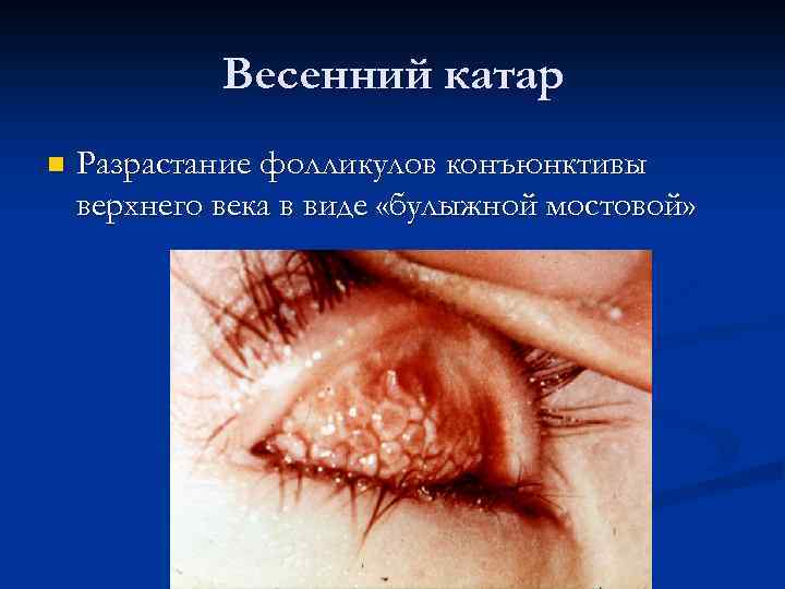 Весенний катар n Разрастание фолликулов конъюнктивы верхнего века в виде «булыжной мостовой» 