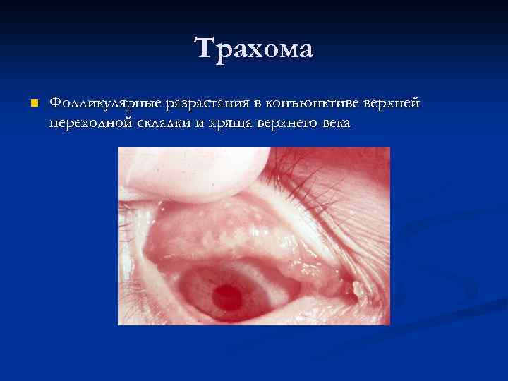 Трахома n Фолликулярные разрастания в конъюнктиве верхней переходной складки и хряща верхнего века 