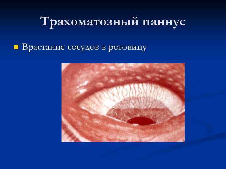 Трахоматозный паннус n Врастание сосудов в роговицу 
