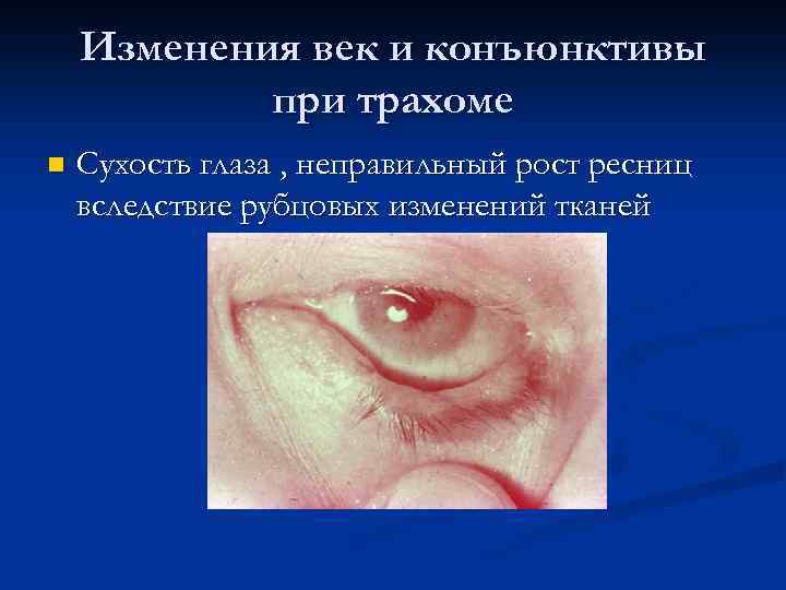 Изменения век и конъюнктивы при трахоме n Сухость глаза , неправильный рост ресниц вследствие