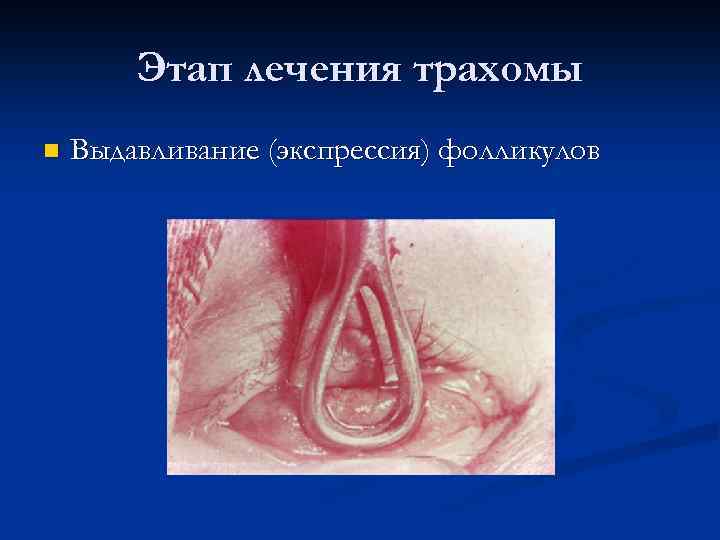 Этап лечения трахомы n Выдавливание (экспрессия) фолликулов 