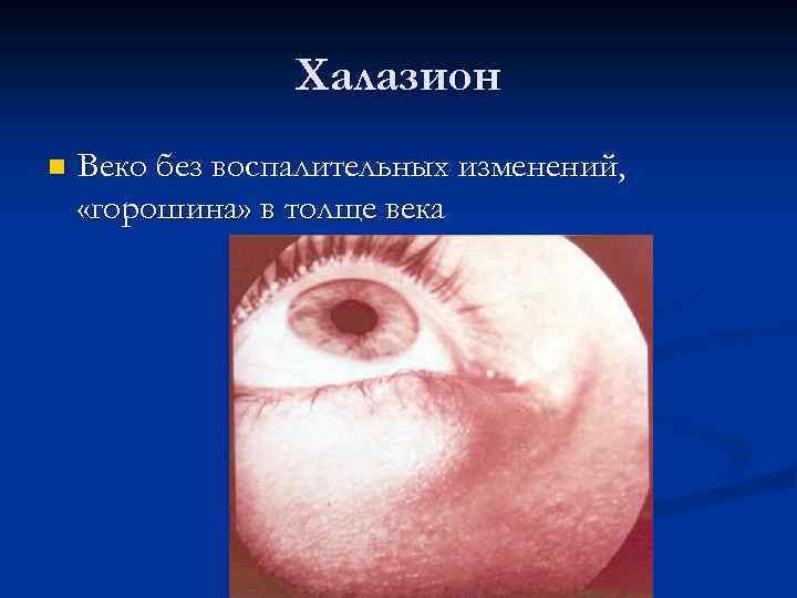Халазион n Веко без воспалительных изменений, «горошина» в толще века 