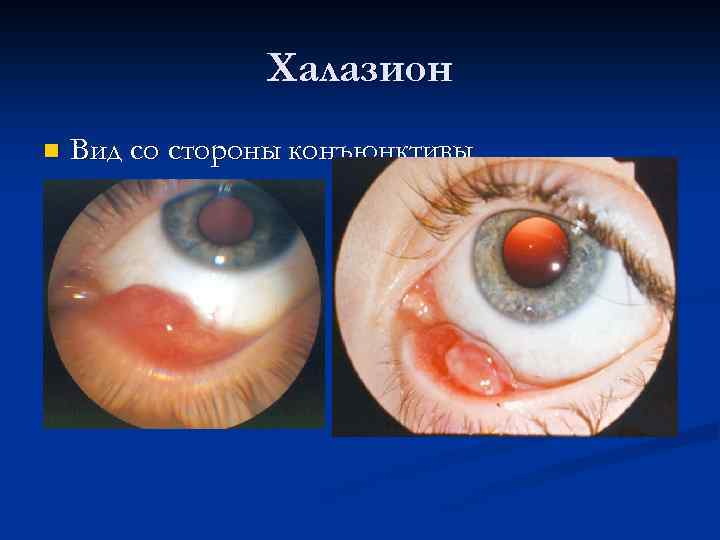 Халазион n Вид со стороны конъюнктивы 
