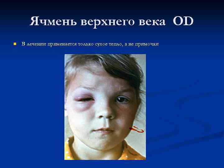 Ячмень верхнего века OD n В лечении применяется только сухое тепло, а не примочки