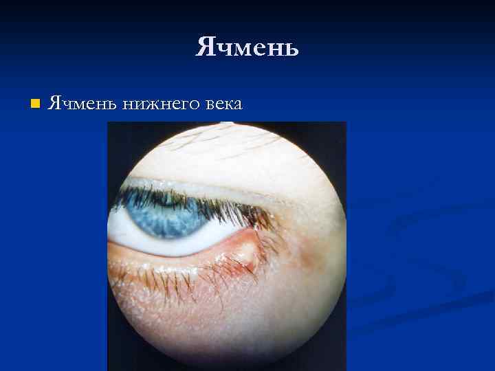 Ячмень n Ячмень нижнего века 