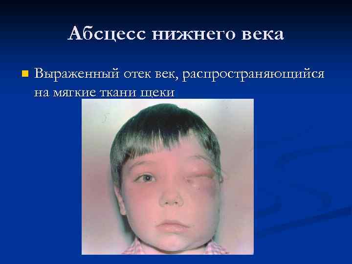 Абсцесс нижнего века n Выраженный отек век, распространяющийся на мягкие ткани щеки 