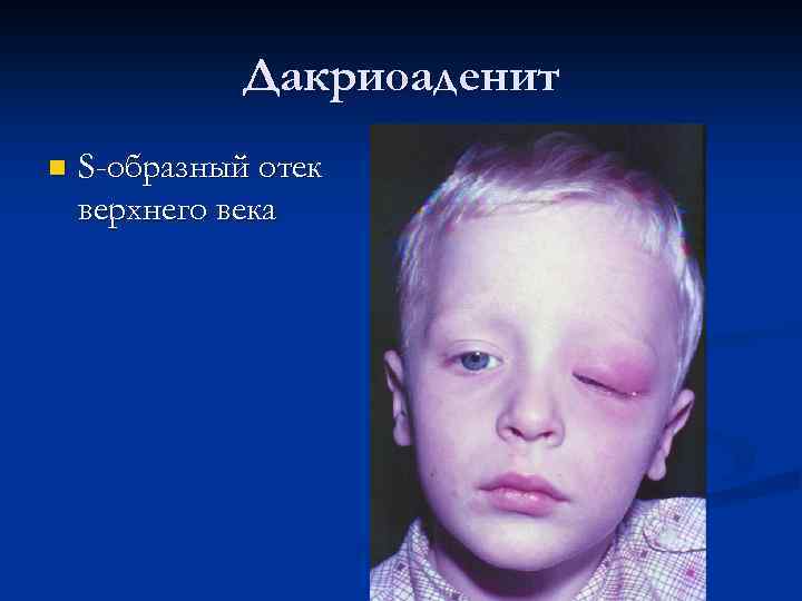 Дакриоаденит n S-образный отек верхнего века 